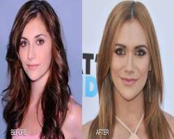 Alyson Stoner before surgery