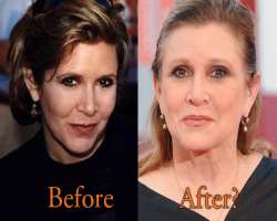 Carrie Fisher before surgery Carrie Fisher before surgery