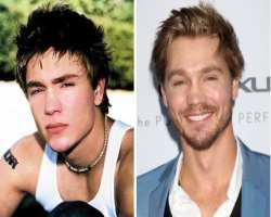 Chad Michael Murray before surgery Chad Michael Murray before surgery