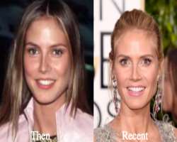 Heidi Klum before surgery