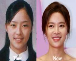 Hwang Jung-eum before surgery