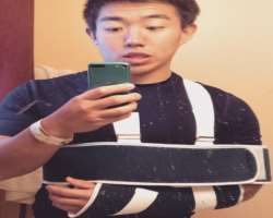 He fractured his hand in early 2015.