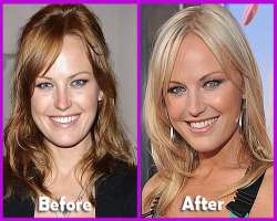 Malin Akerman before surgery