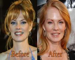 marg helgenberger plastic surgery