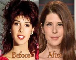 Marisa Tomei before surgery