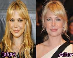 Michelle Williams before surgery