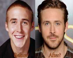 Ryan Gosling before surgery Ryan Gosling before surgery