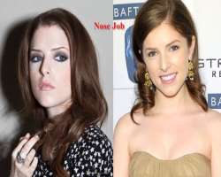 Anna Kendrick before surgery