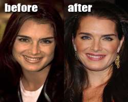 Brooke Shields before surgery