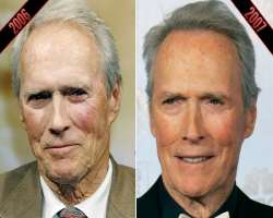 Clint Eastwood before surgery