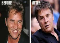 Don Johnson before surgery Don Johnson before surgery