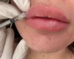 Nicole Pallado before surgery