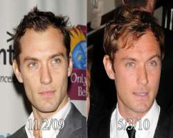 Jude Law before surgery