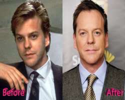 Kiefer Sutherland before surgery