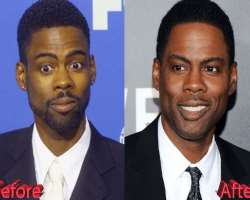 Chris Rock before surgery