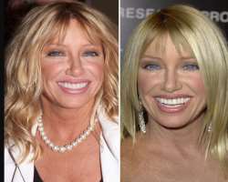 Suzanne Somers before surgery