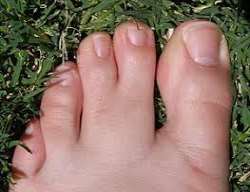 He was a victim of syndactylism and takes off his shoes and socks on screen in  Mr. Mike's Mondo Video to show this anomaly.
