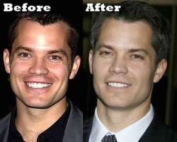 Timothy Olyphant before surgery